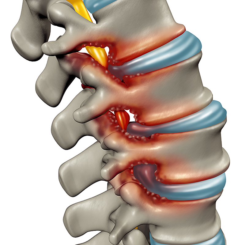 Spinal Canal Stenosis Treatment